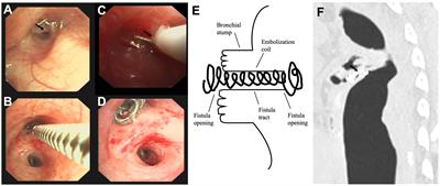 Case report: Endobronchial closure of postoperative bronchopleural fistula with embolization coil: a sandwich-like approach